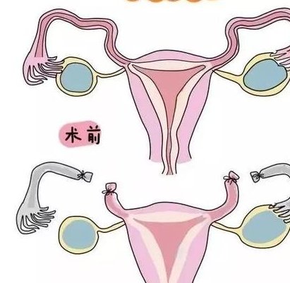 2026去美国做试管婴儿并不麻烦，只需4个步骤就能搞定